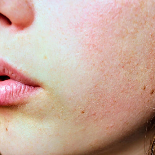Peau à texture irrégulière à Lausanne Peau à texture irrégulière à Lausanne