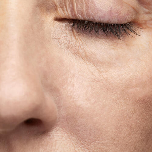 Peau terne à Lausanne Peau terne à Lausanne