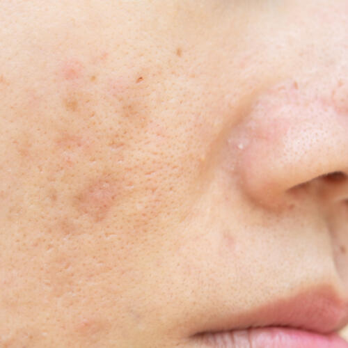 Taches pigmentaires à Lausanne Taches pigmentaires à Lausanne